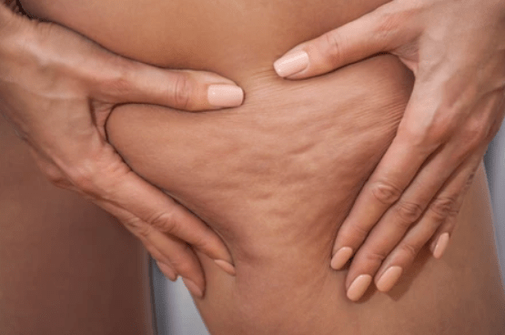 Cellulite Myths Vs Facts Illustration comparing common cellulite treatment myths with the facts
