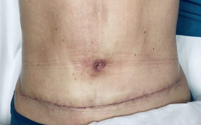 Benefits of Lymphatic Massage Post-Plastic Surgery
